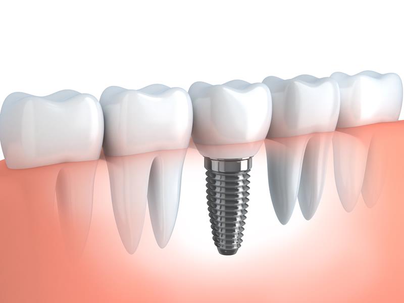 Dental Implants  Round Rock, TX