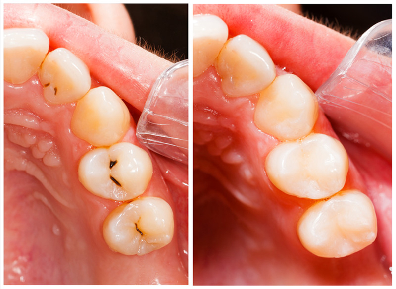 Fillings  Round Rock, TX 